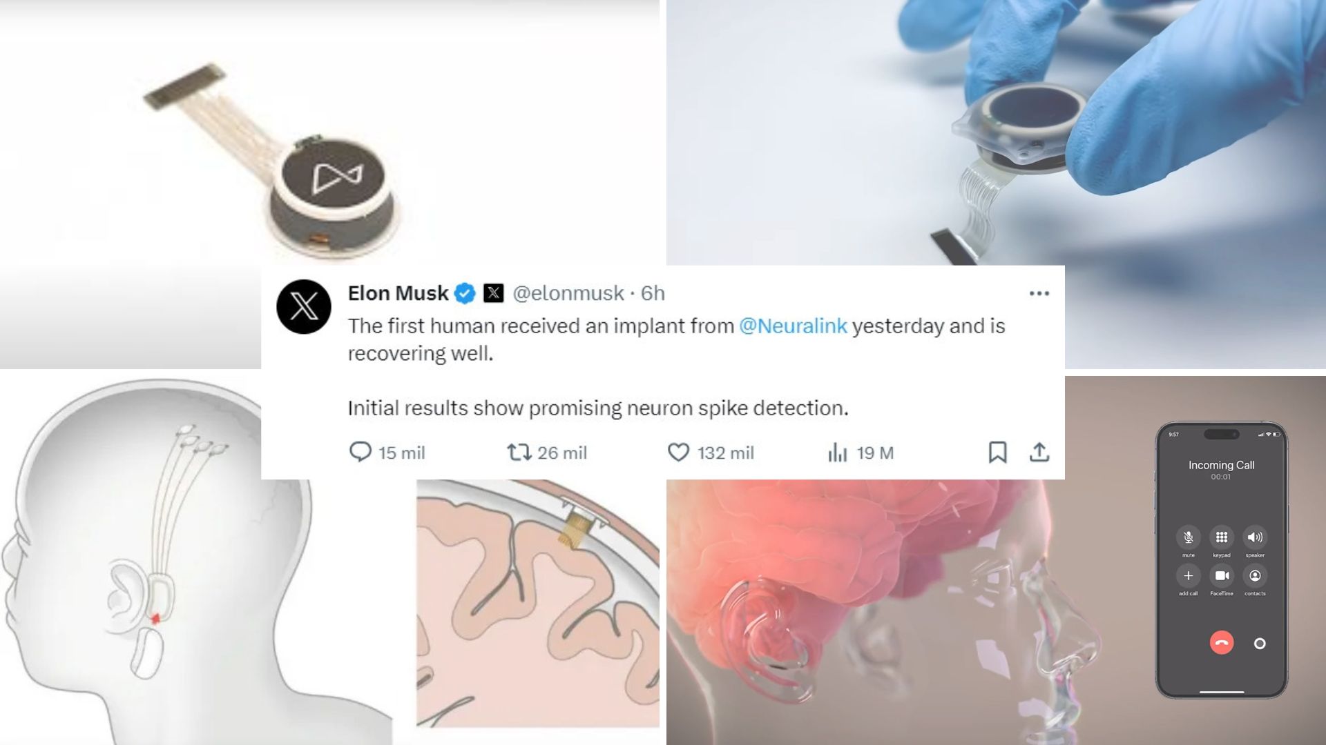 El implante, llamado Telepathy, permite controlar un movil o PC con solo pensar.